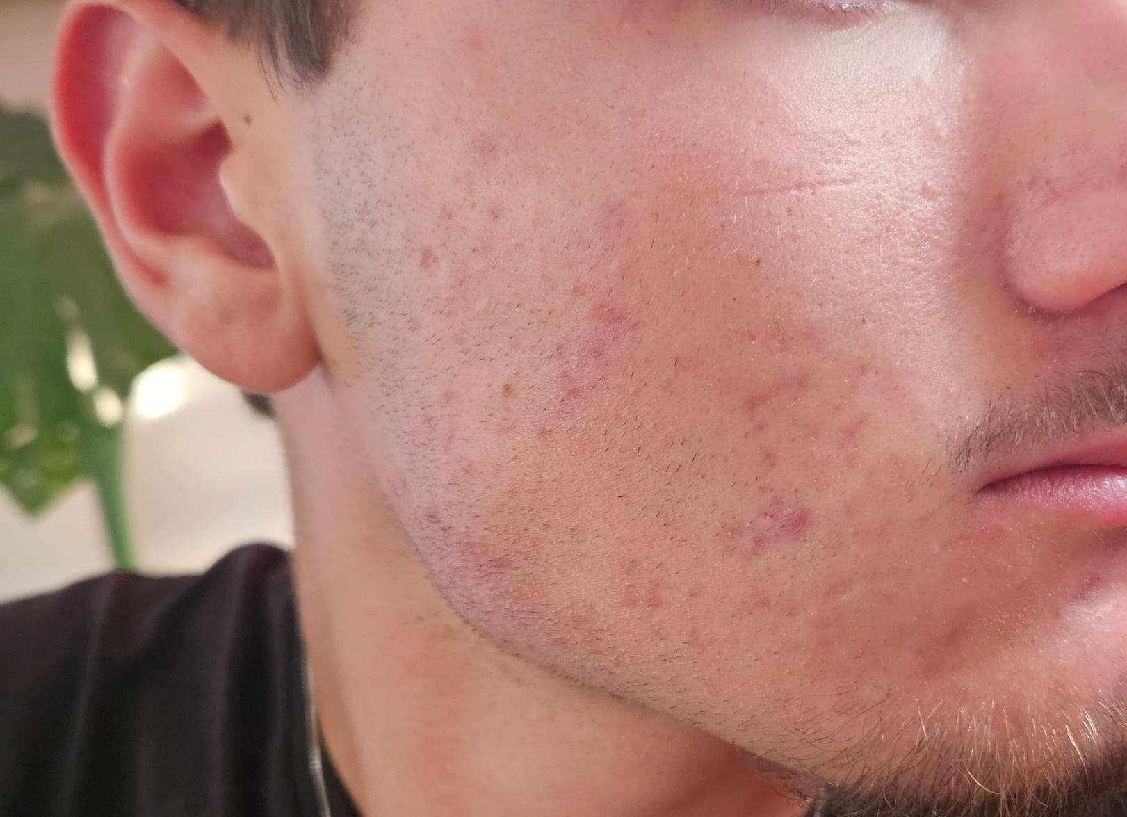 Acné traitée soin facialiste et kératopraxie