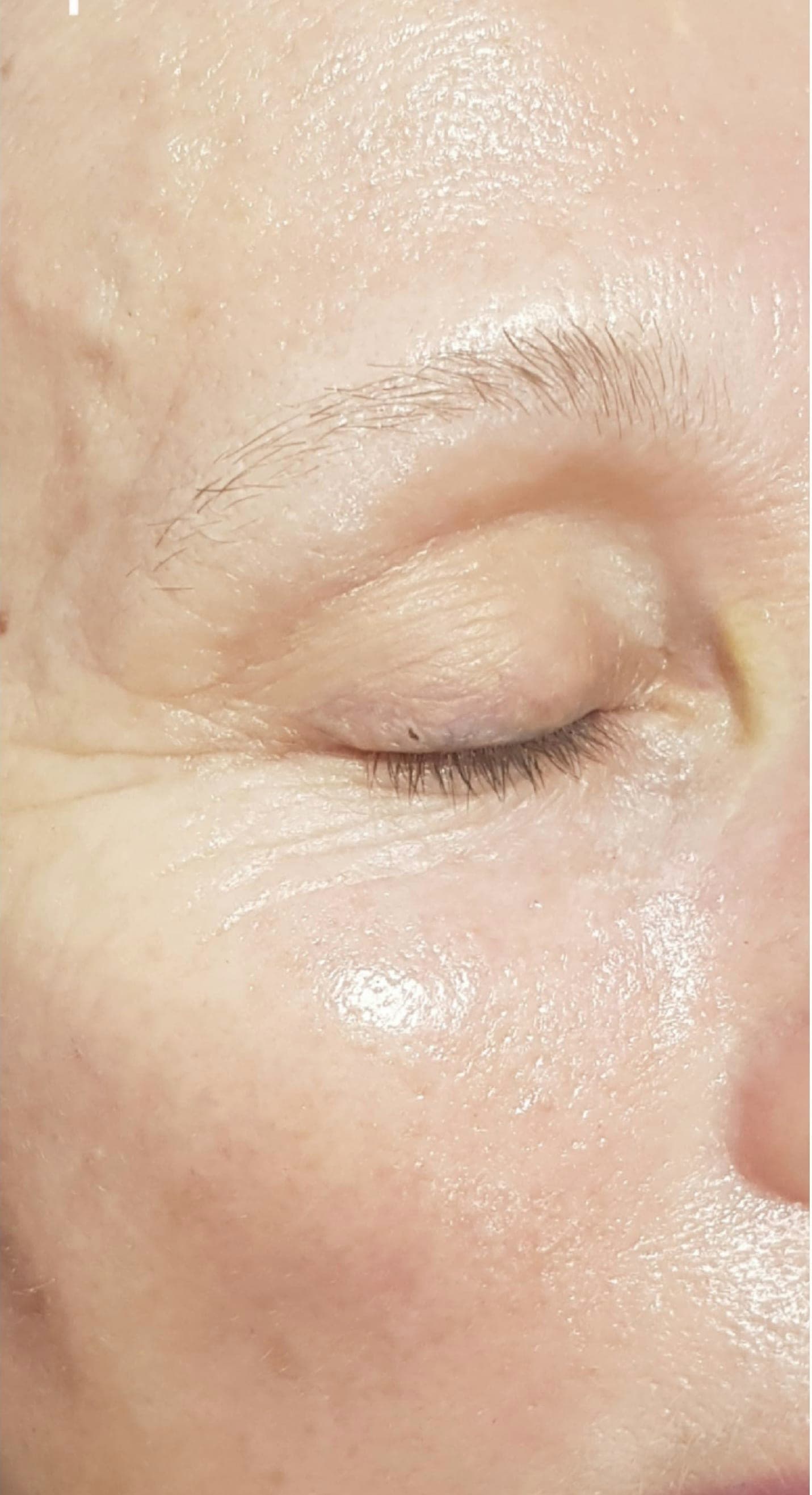 Disparition des rides après traitement